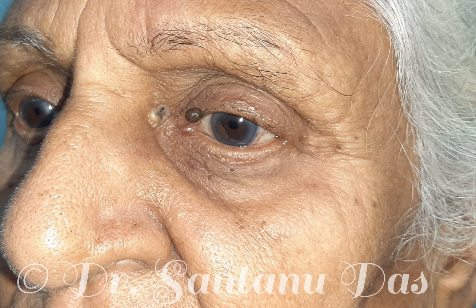 Left upper lid naevus and a sebaceous cyst